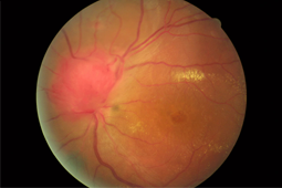 OCT Medoptica