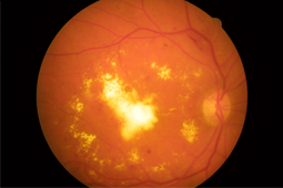 OCT Medoptica
